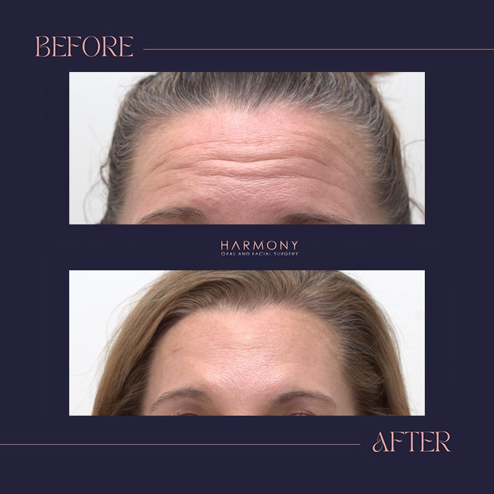 Harmony Oral   Facial Surgery | Replacing Missing Teeth, All-on-4 reg  and Impacted Teeth