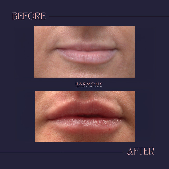 Harmony Oral   Facial Surgery | Bone Grafts, Advanced Grafting for Thin Jaw and Sinus Lift