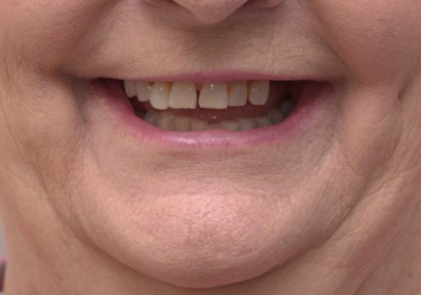 Harmony Oral Facial Surgery | Full Mouth Implants, Facial Trauma and Bone Grafts