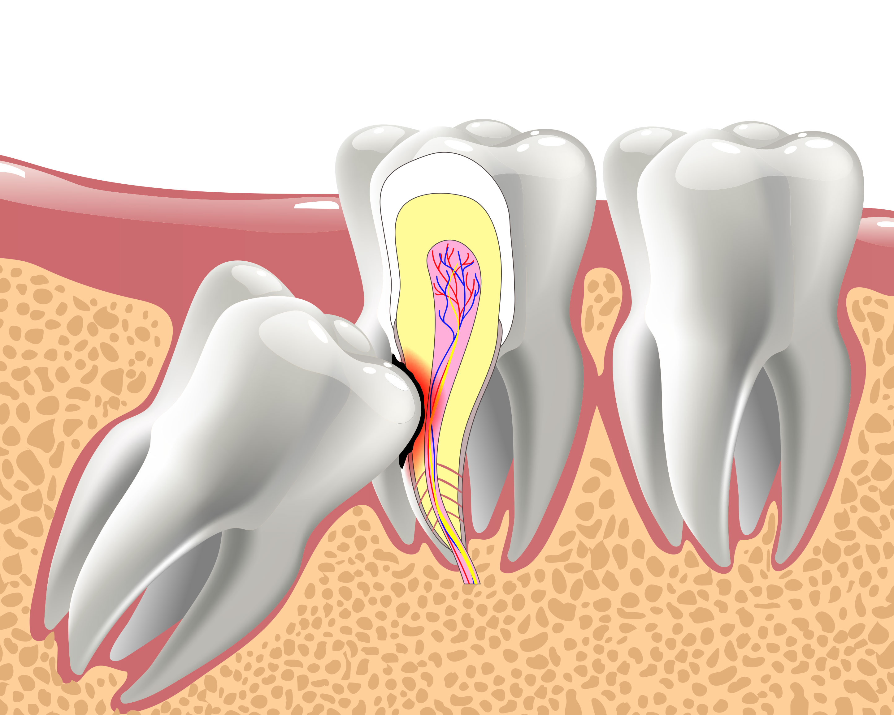 Impacted Wisdom Teeth in Tega Cay
