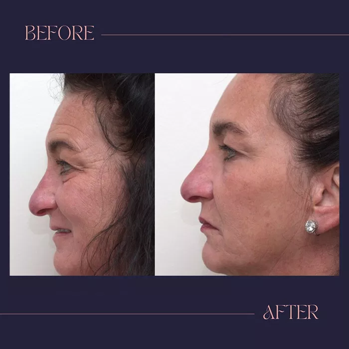 Harmony Oral Facial Surgery | Wisdom Teeth Extractions, Extractions and Ridge Augmentation