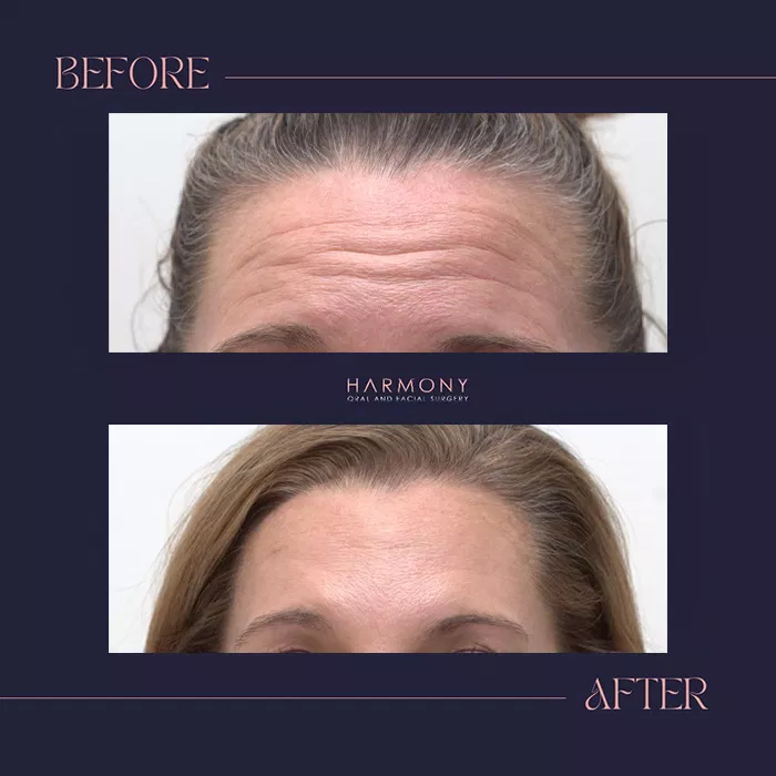 Harmony Oral Facial Surgery | Wisdom Teeth Extractions, Extractions and Ridge Augmentation