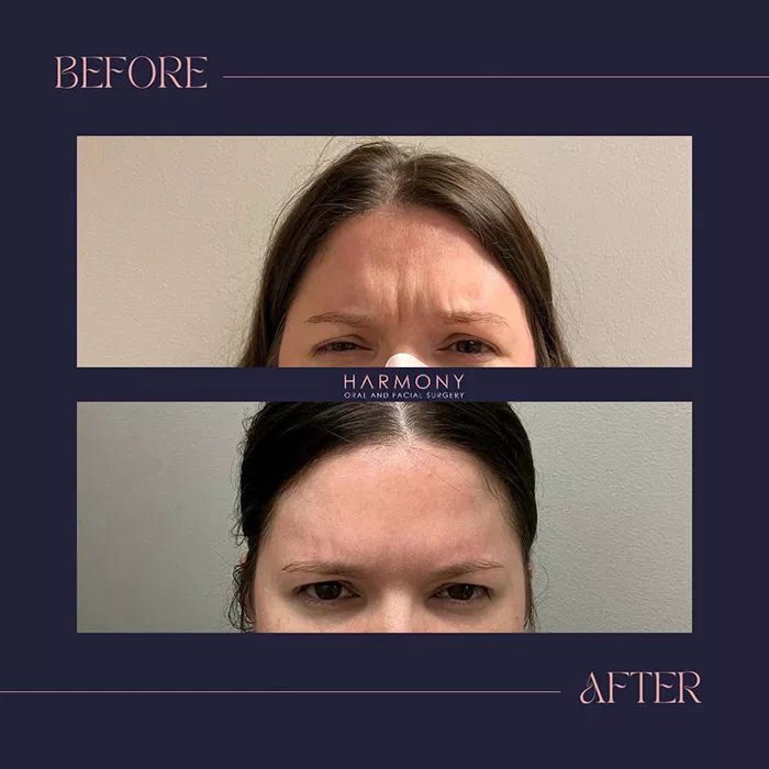Harmony Oral Facial Surgery | Wisdom Teeth Extractions, Extractions and Ridge Augmentation