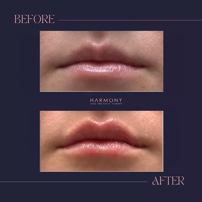 Harmony Oral Facial Surgery | Wisdom Teeth Extractions, Extractions and Ridge Augmentation