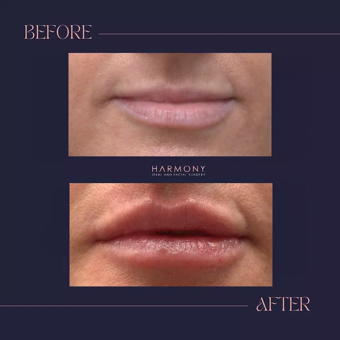 Harmony Oral Facial Surgery | Wisdom Teeth Extractions, Extractions and Ridge Augmentation