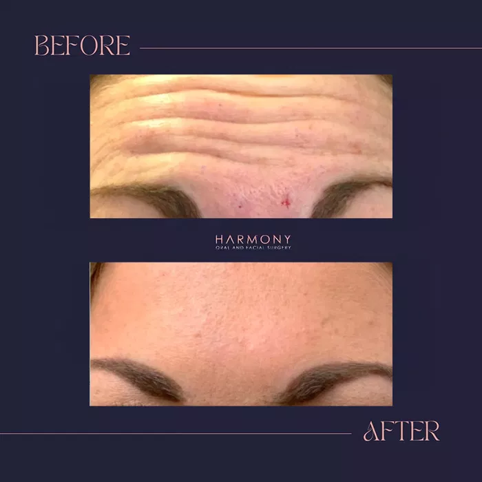 Harmony Oral Facial Surgery | Wisdom Teeth Extractions, Extractions and Ridge Augmentation