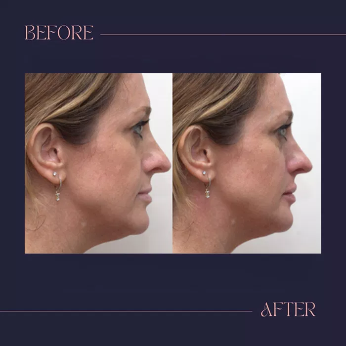 Harmony Oral Facial Surgery | Wisdom Teeth Extractions, Extractions and Ridge Augmentation