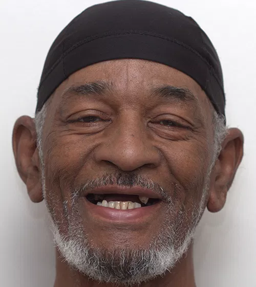 Harmony Oral Facial Surgery | Bone Grafts, Advanced Grafting for Thin Jaw and Oral Sedation