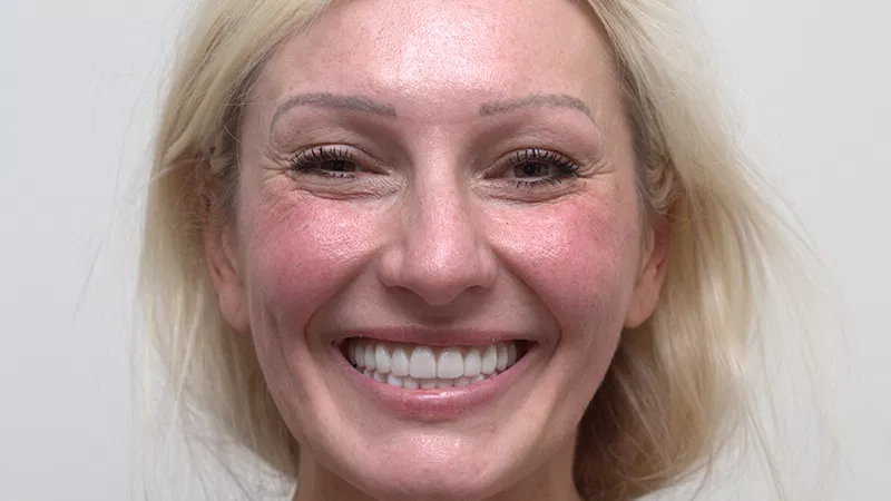 Harmony Oral Facial Surgery | IV Sedation, Microneedling and Fillers
