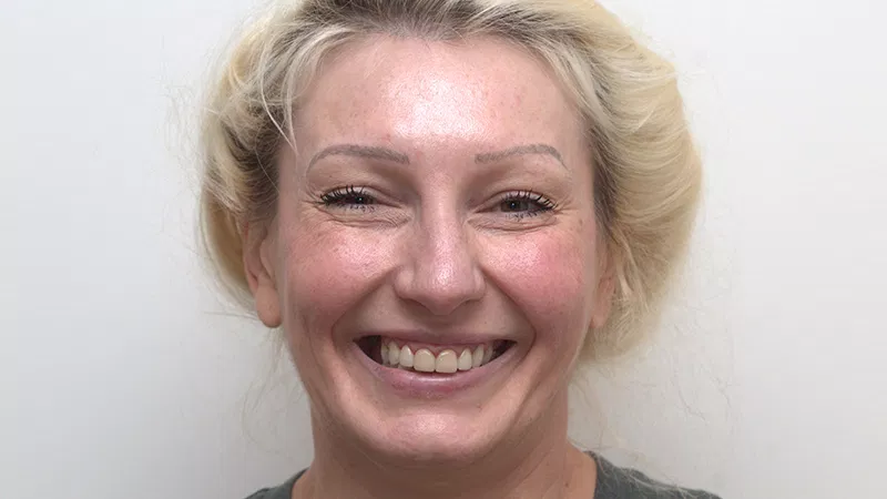 Harmony Oral Facial Surgery | Fillers, Emergency Treatment and Zygomatic Implants
