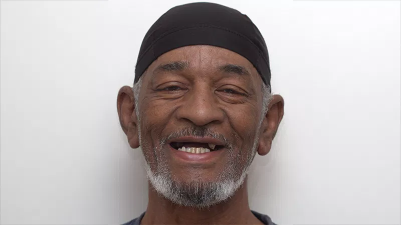 Harmony Oral Facial Surgery | Socket Preservation, Replacing Missing Teeth and Sinus Lift
