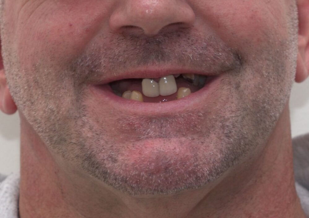 All-on-4 dental implants second before result at Harmony Oral Surgery Charlotte