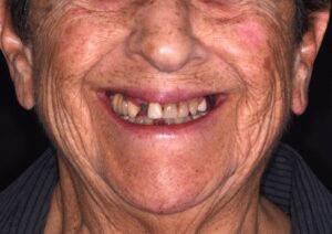 All-on-4 dental implants before result at Harmony Oral Surgery Charlotte